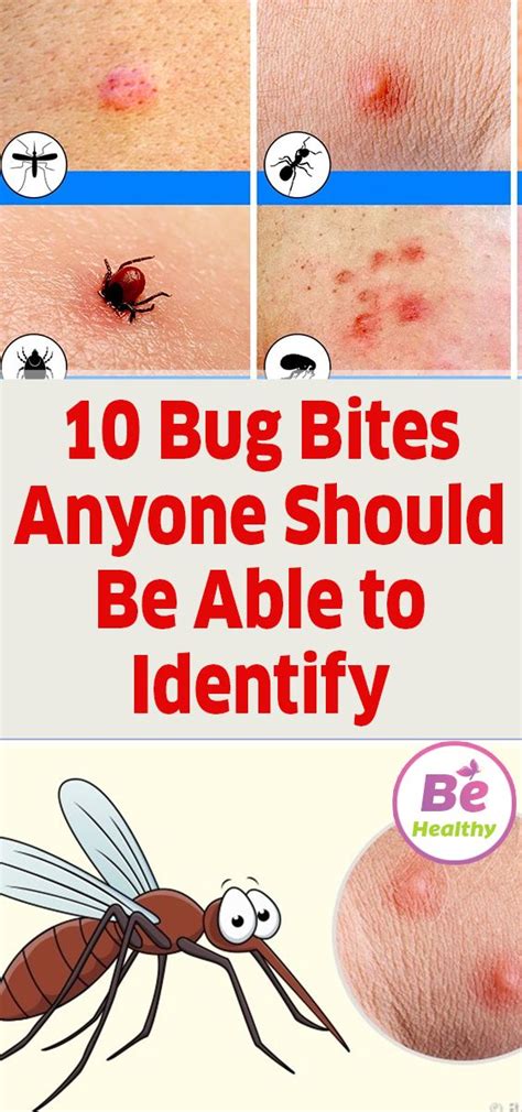 bite 15 cm|how to identify bug bites.